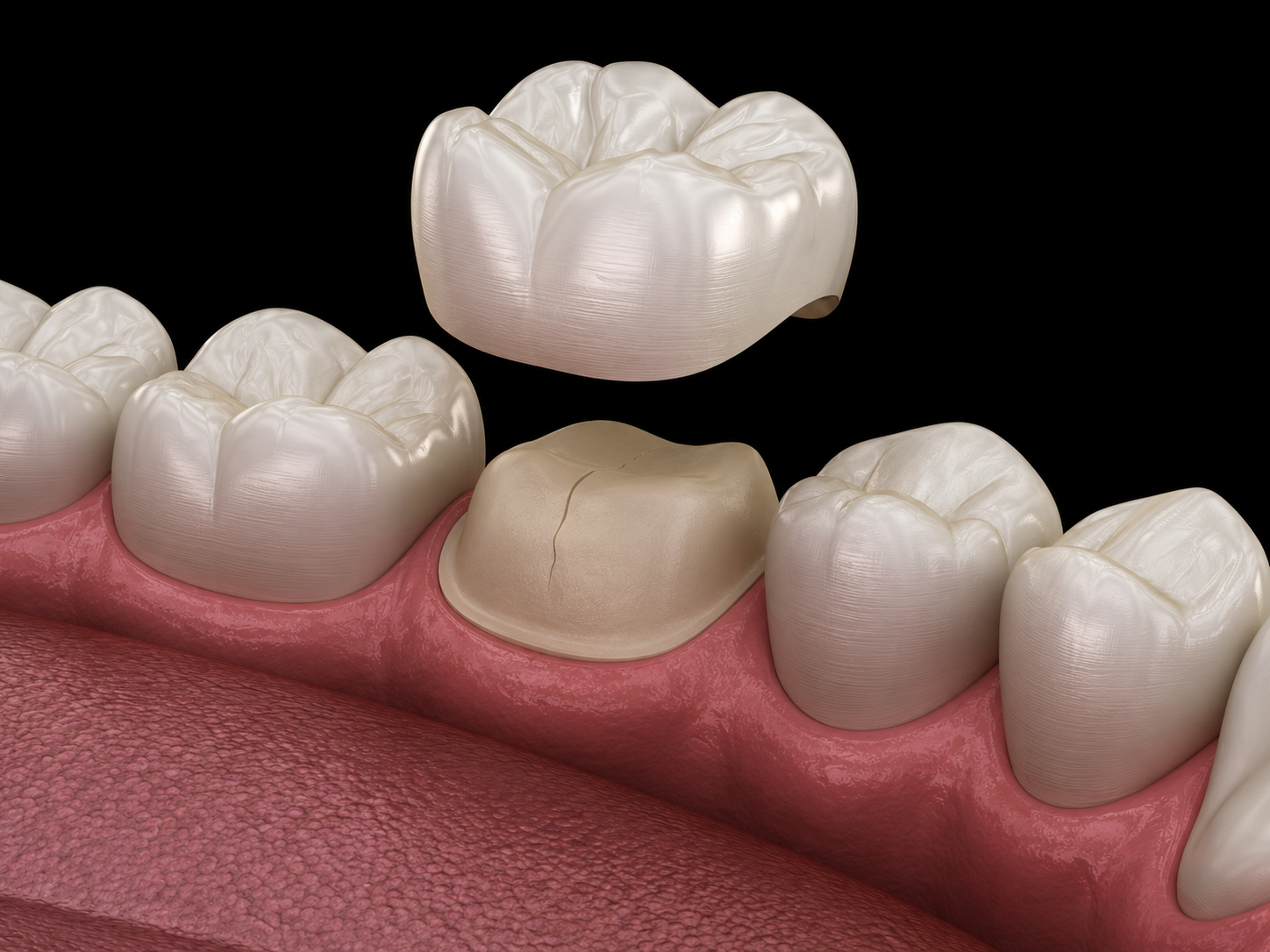 Ceramic crown being placed over a prepared molar with a visible crack