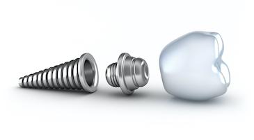 dental implant