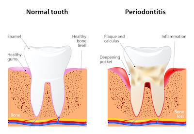 normal tooth compared to tooth and gums with periodontal disease