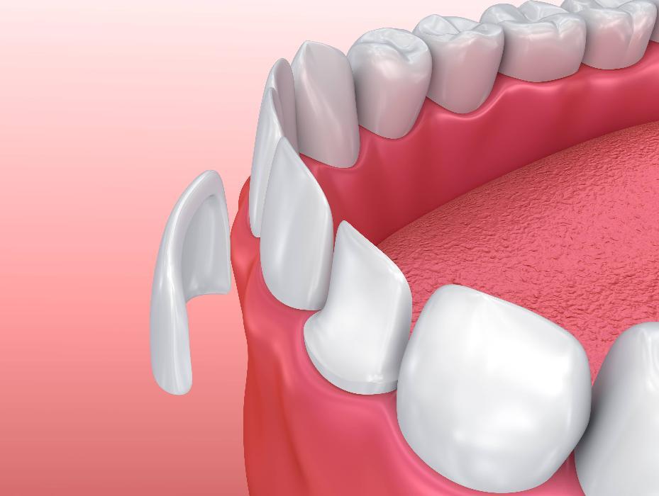 Diagram of veneer covering tooth in Brisbane CBD