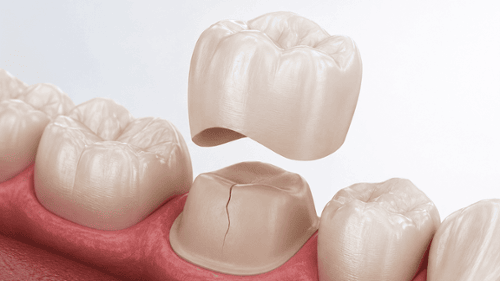 Dental crown positioned above a prepared cracked molar