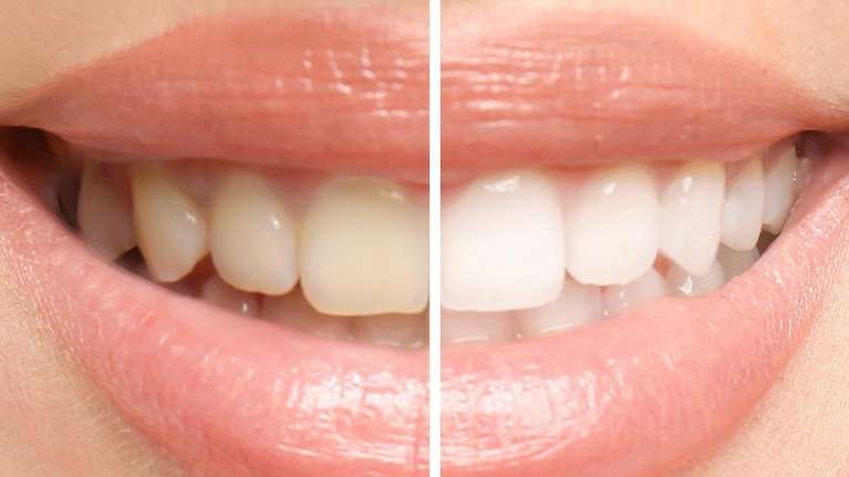 close up of smile side by side before and after teeth whitening