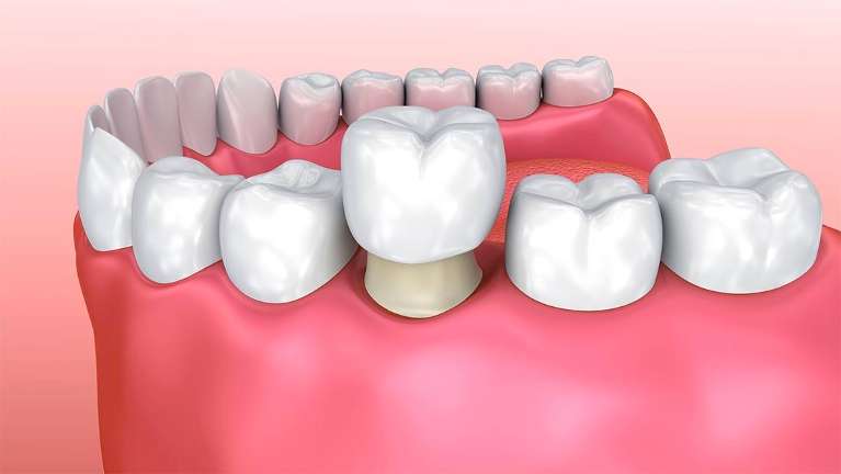 Digital graphic of same day dental crown in Brisbane