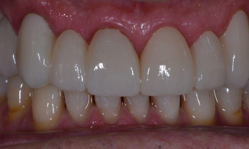 Close up of teeth after 12 dental crowns in Brisbane CBD