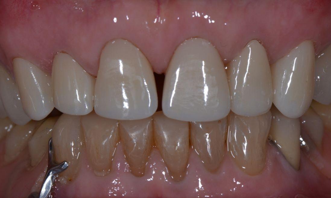 Teeth after dental crown placement in Brisbane, QLD