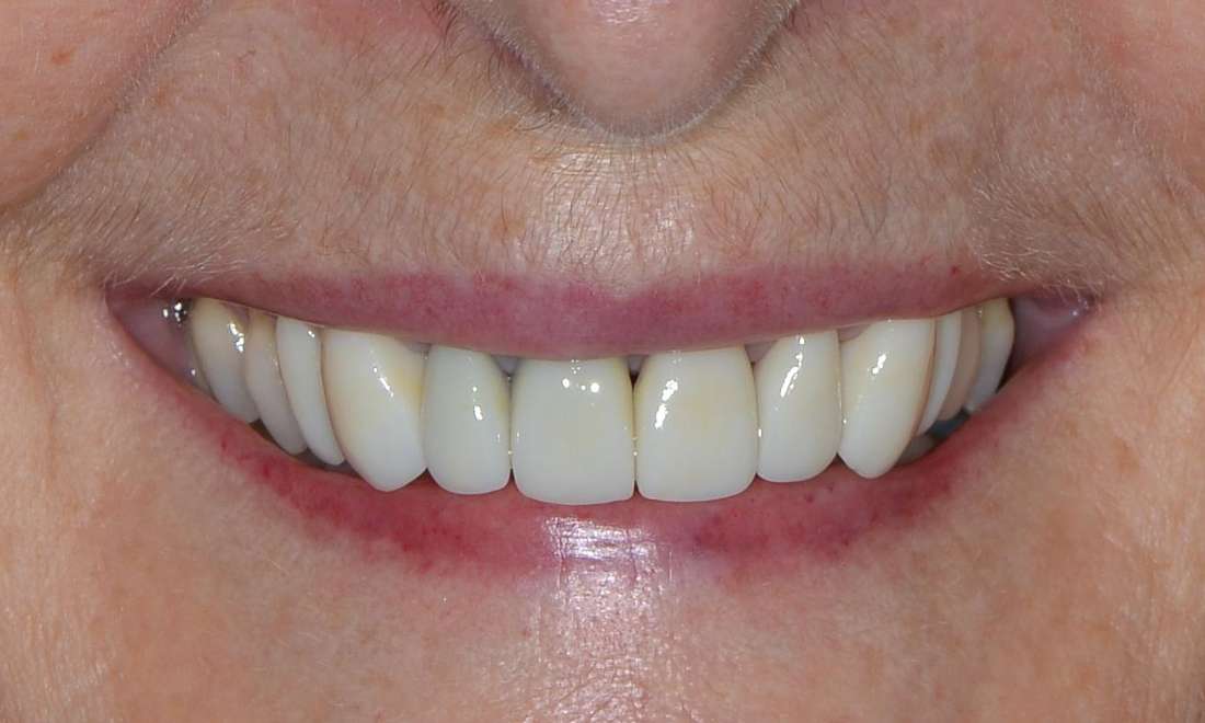 Porcelain crowns in Brisbane CBD after