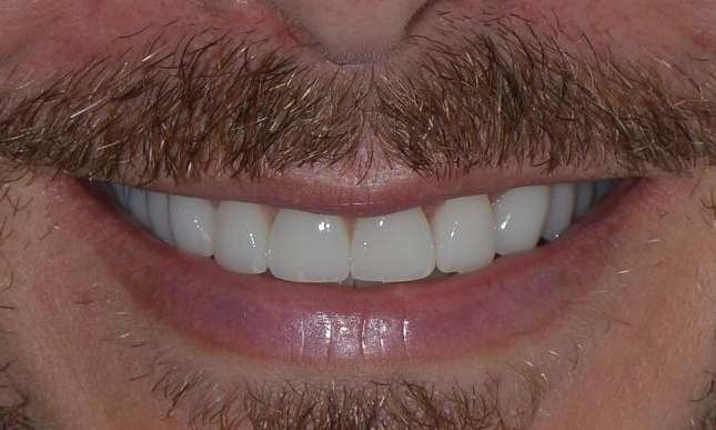 Veneers in Brisbane CBD after image