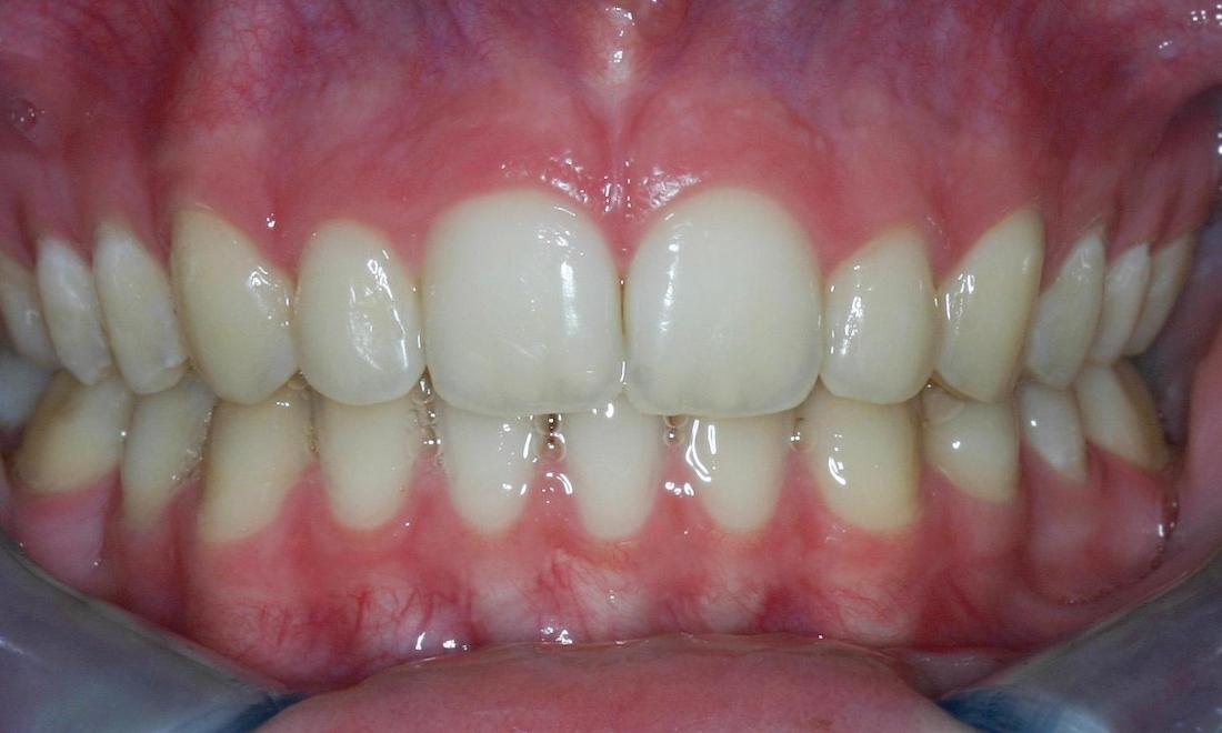 Teeth after Invisalign aligners in Brisbane CBD
