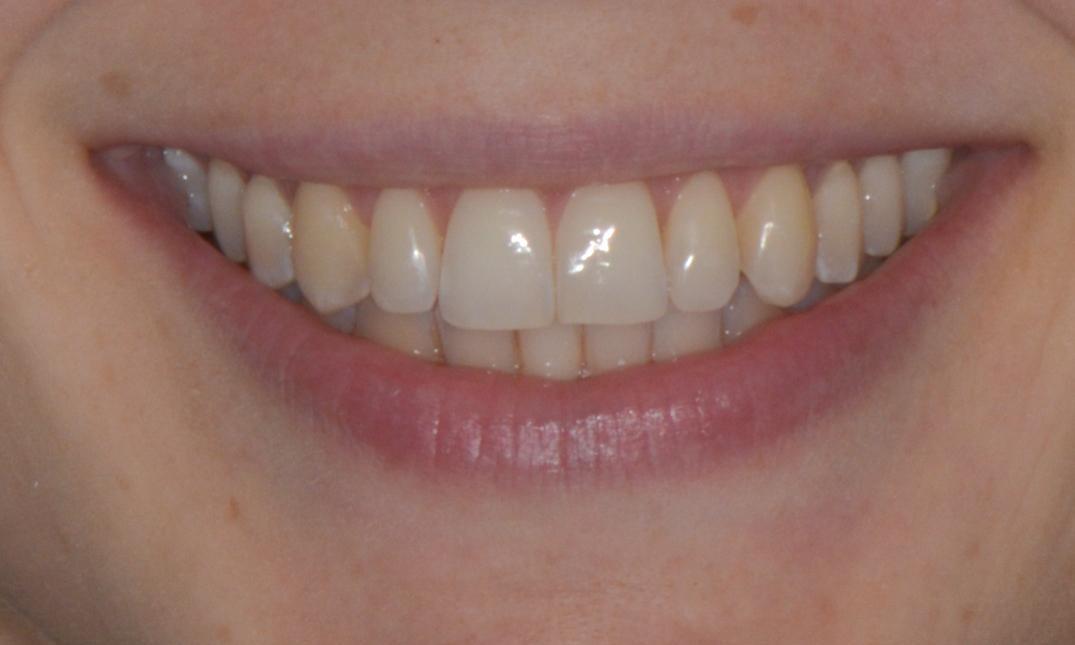 Patients teeth after Invisalign in Brisbane, QLD