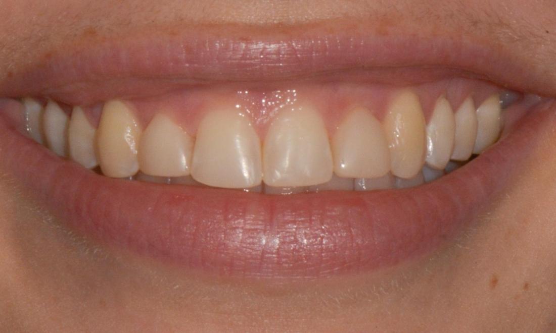 Results from Invisalign treatment in Brisbane City