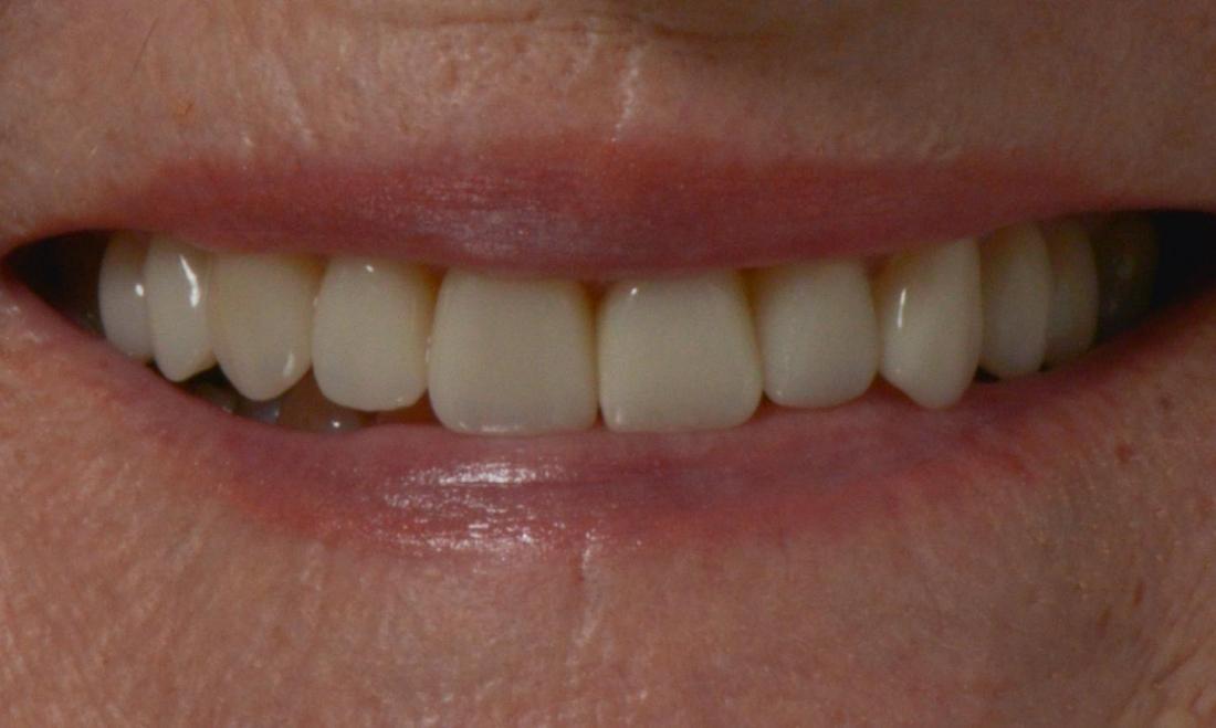 Close up of teeth after dental crowns in Brisbane, QLD