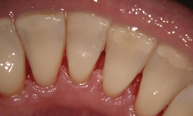 back of teeth after a thorough cleaning