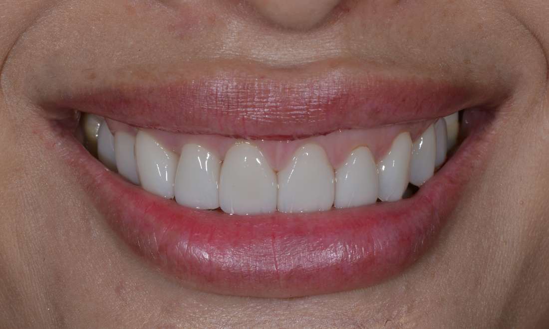 patient's smile after porcelain veneers on front teeth