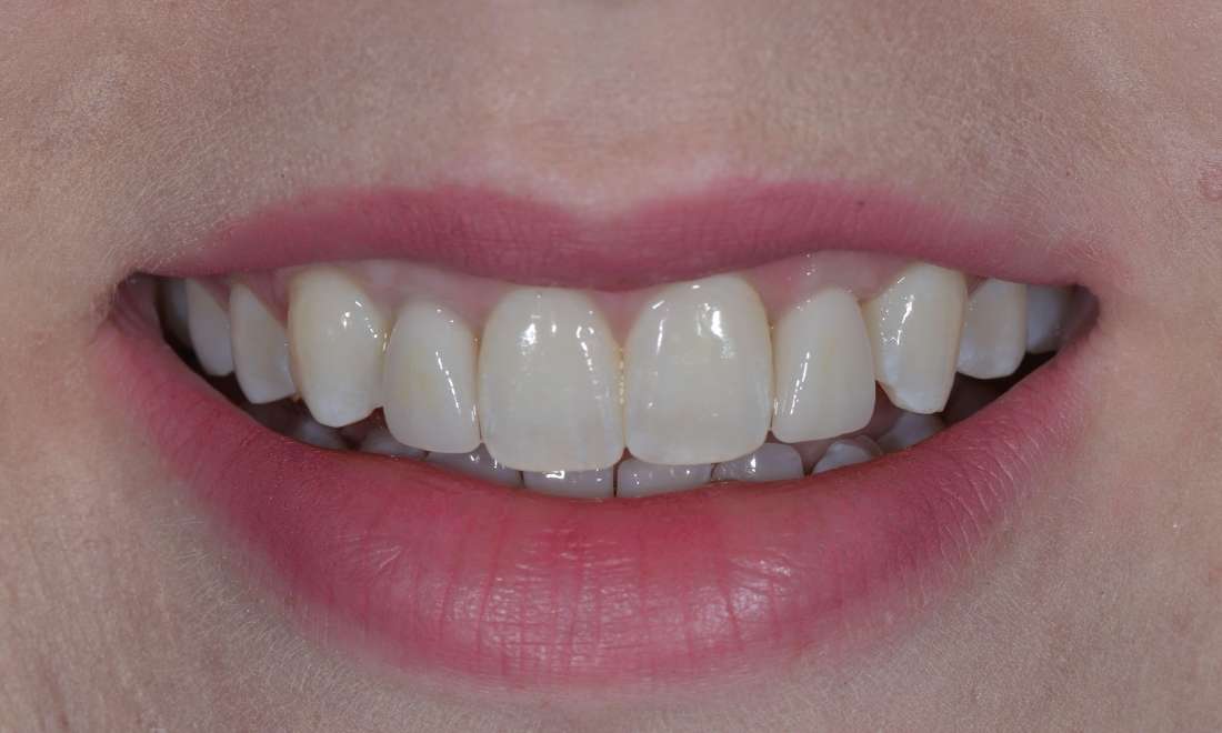 Brisbane Residual Baby Teeth