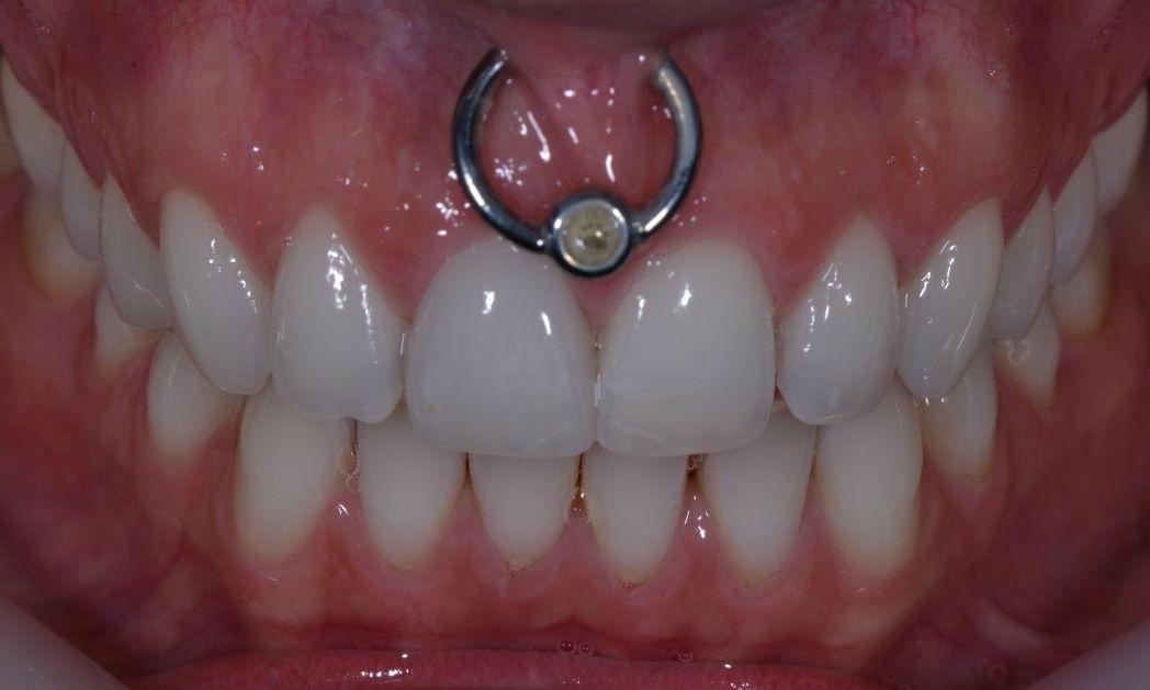 Results from dental crown procedure in Brisbane CBD