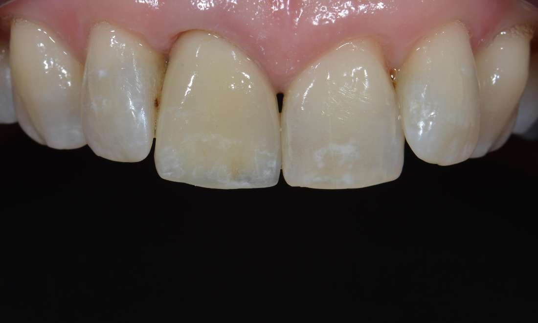 tooth after replacing front old porcelain crown