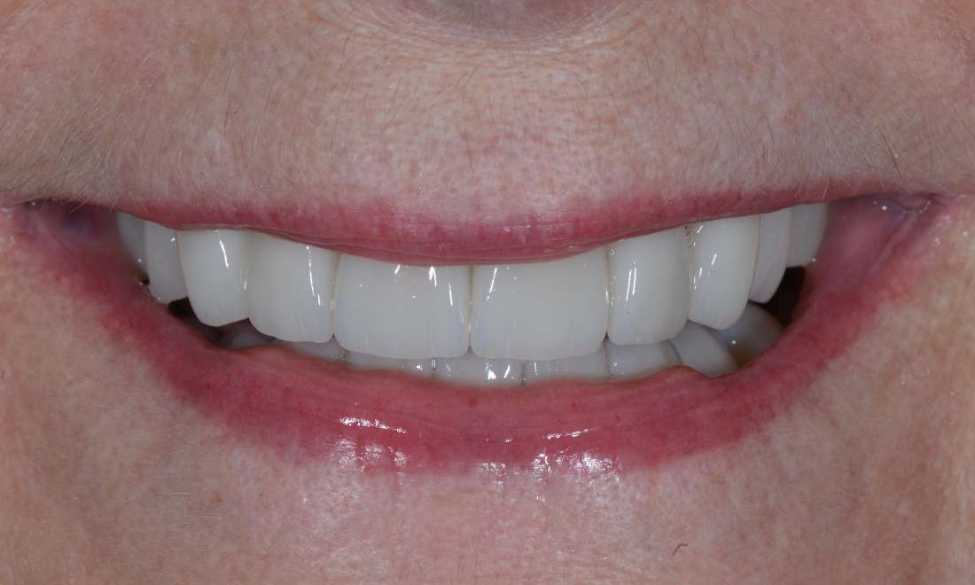 woman's uniform smile after veneers 
