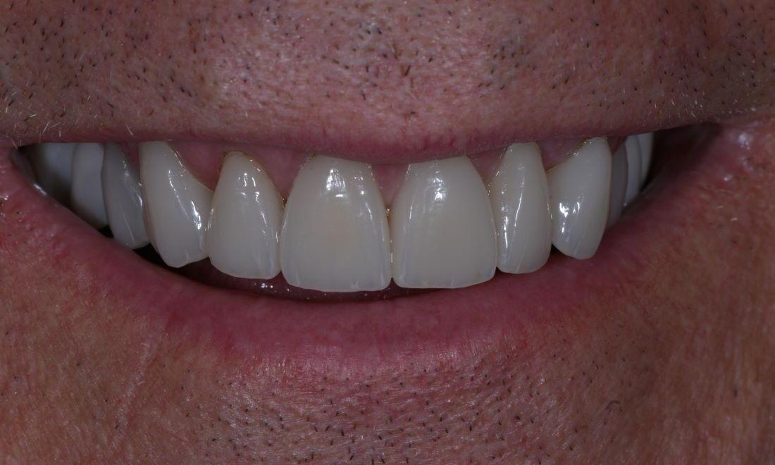 Teeth after cosmetic dentistry in Brisbane CBD