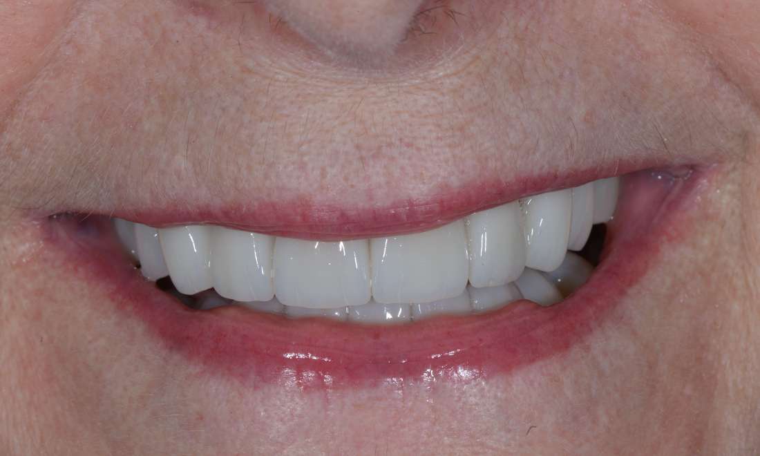 Replacement of existing veneers