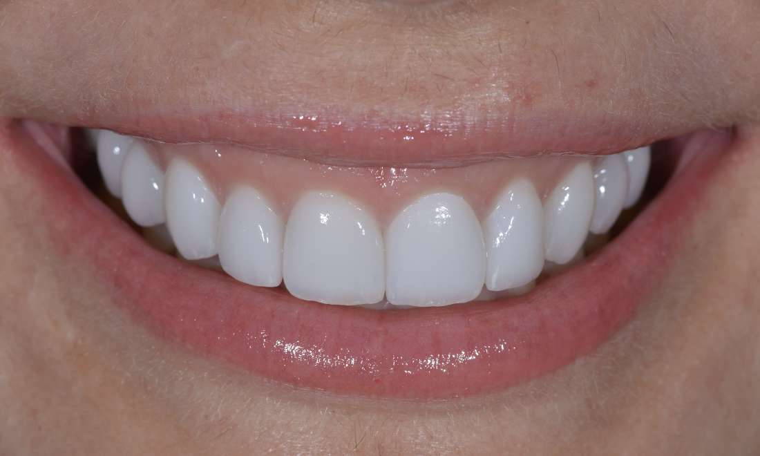 Brisbane Dentist Upper Veneers