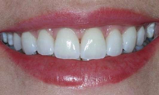 patient's smile after teeth whitening and veneers