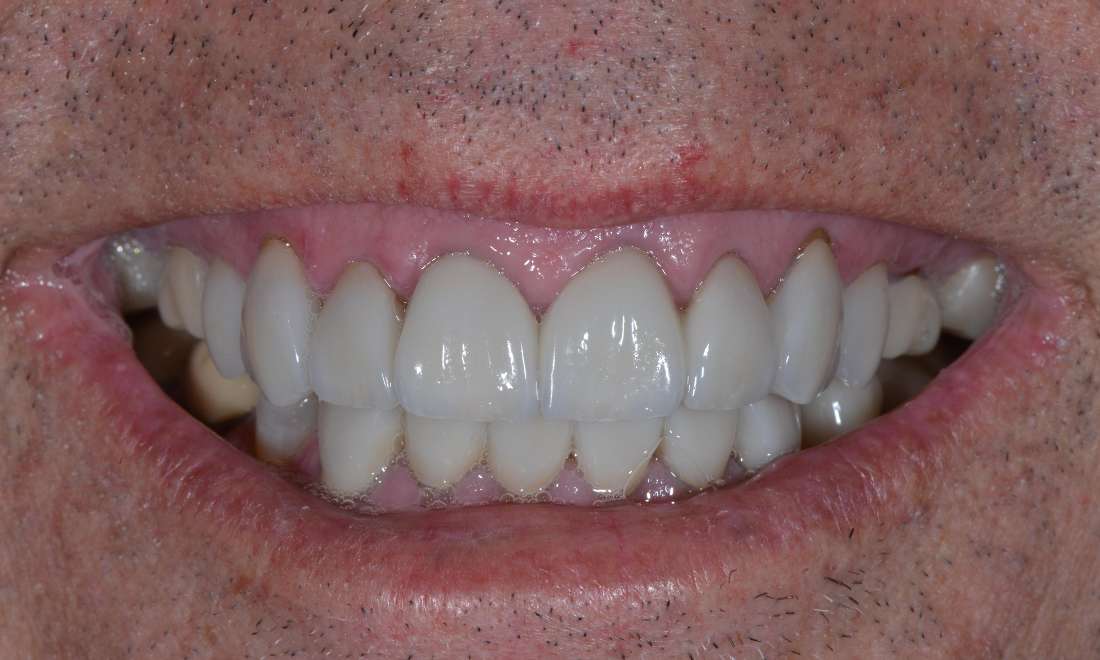 close up of patient's smile after getting cosmetic dentistry