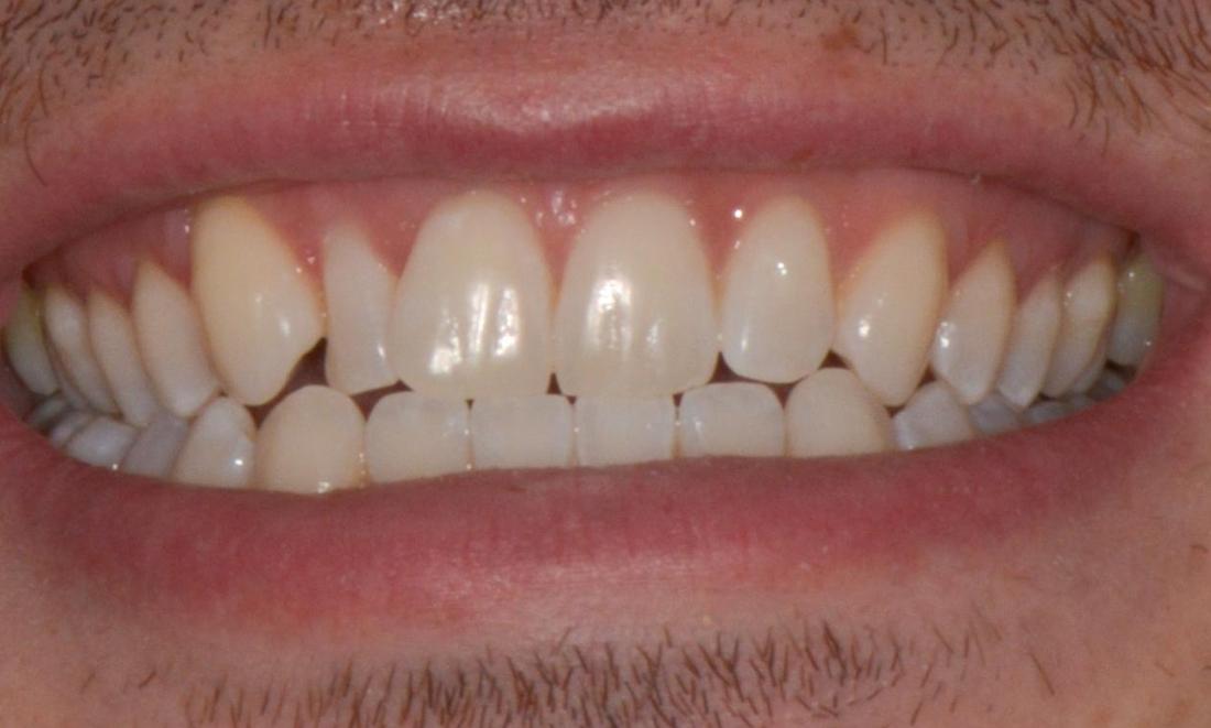 Results from professional teeth whitening in Brisbane CBD