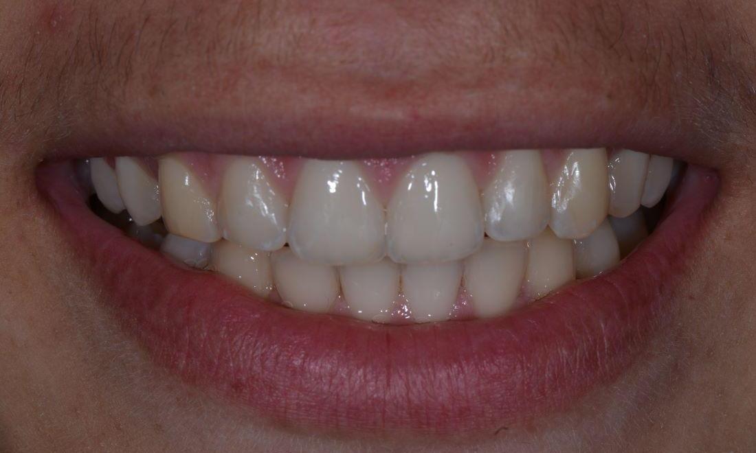 Teeth after Invisalign treatment at dentist in Brisbane CBD