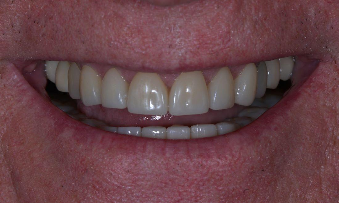 Patients smile after dental crowns in CBD Brisbane