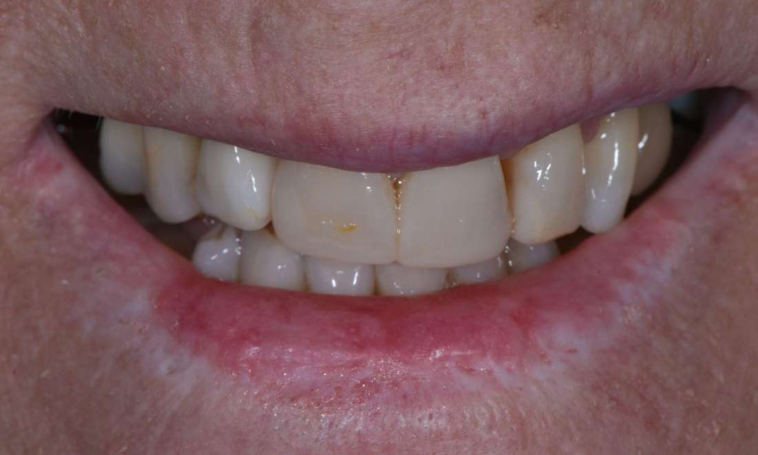 Porcelain Crowns Dr Malcolm Campbell before Image