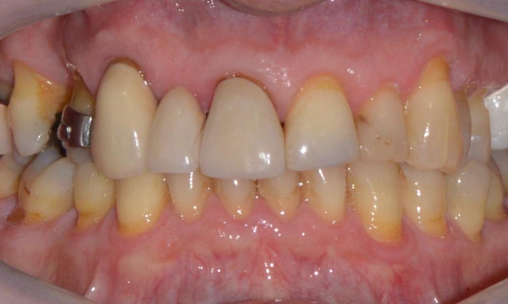 Close up of decayed teeth before dental crowns in Brisbane City