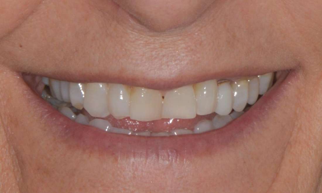 Brisbane Porcelain Crowns Same Day Before Photo