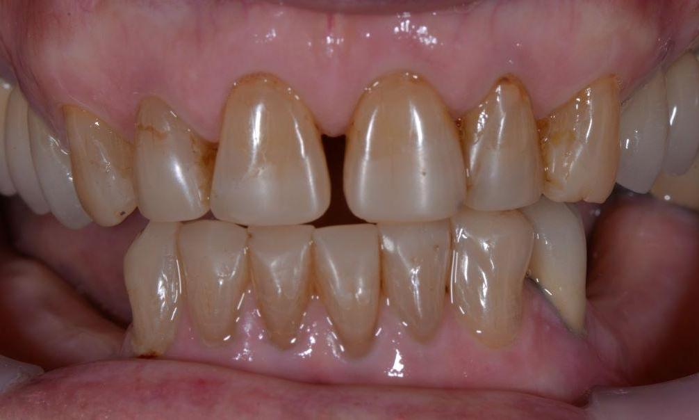Close up of decayed teeth before crown procedure at Brisbane dentist