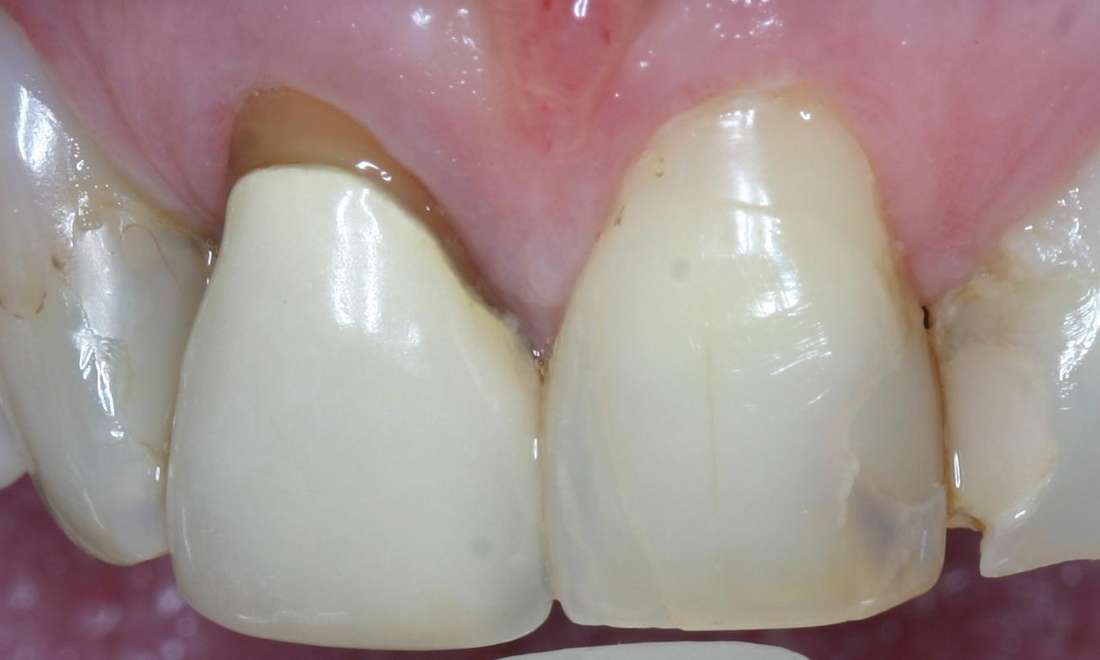 Brisbane old Crowns Before