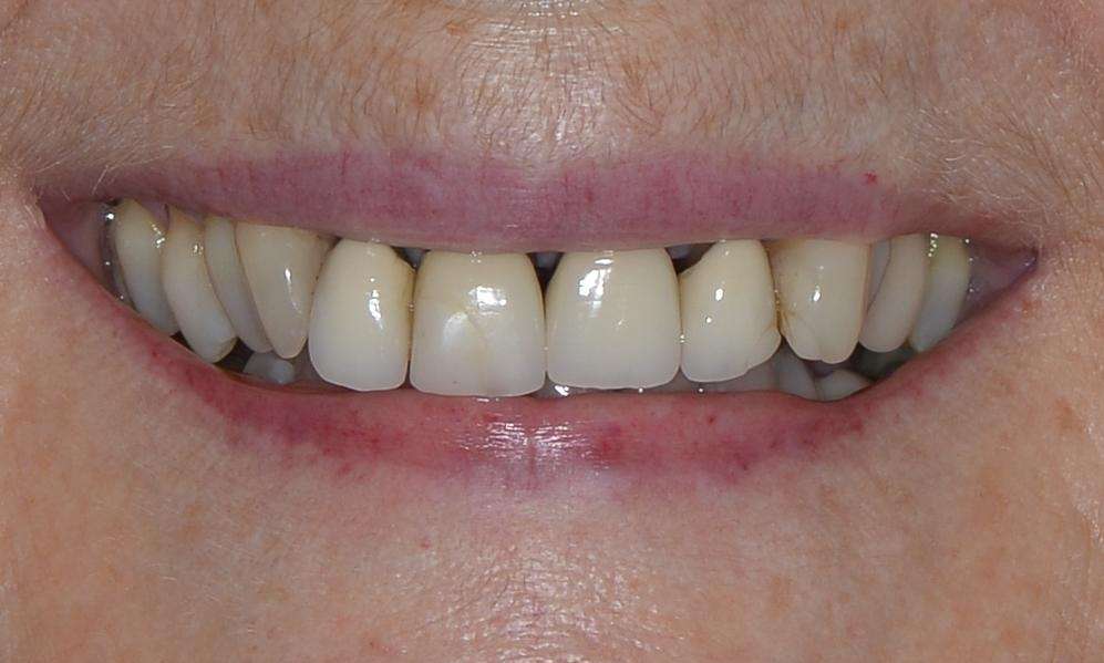 Porcelain crowns in Brisbane CBD Before