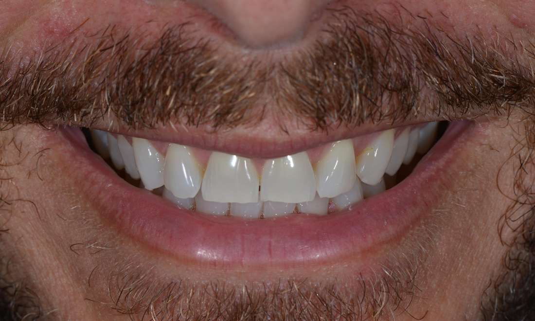 Veneers in Brisbane CBD before image