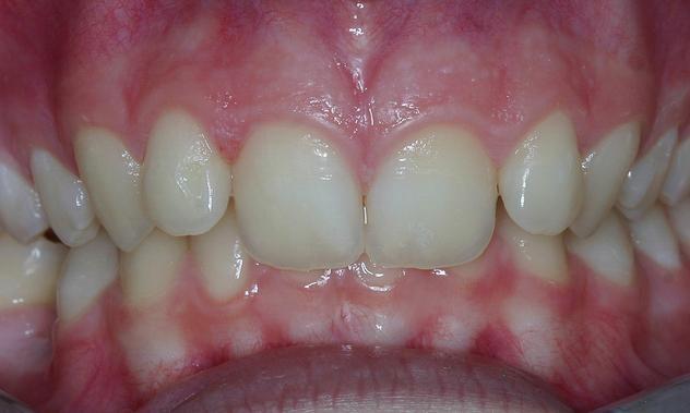 Close up of teeth before Invisalign clear braces in Brisbane