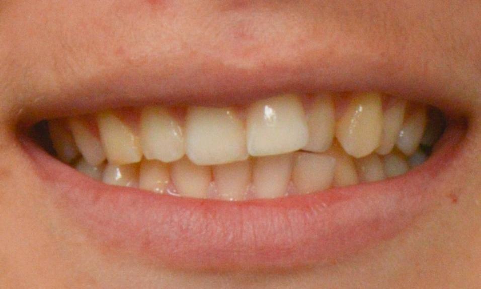 Patients smile before Invisalign in Brisbane CBD