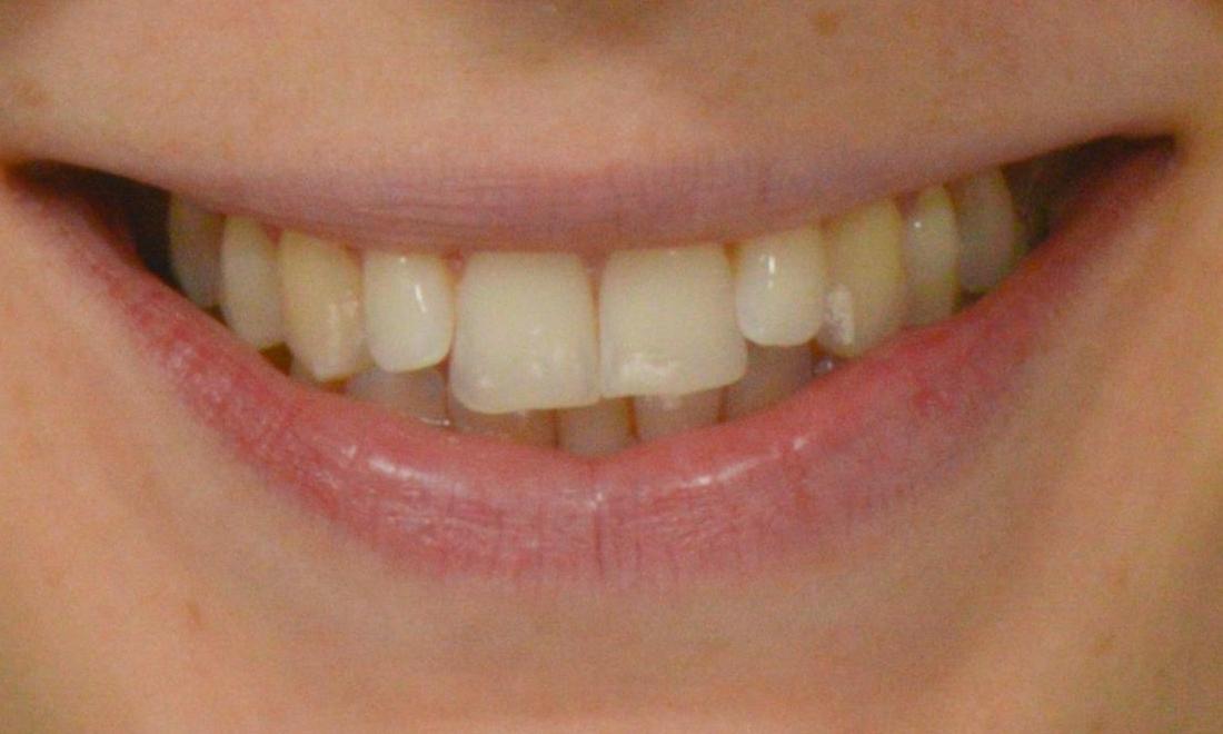 Patients smile before Invisalign in Brisbane CBD