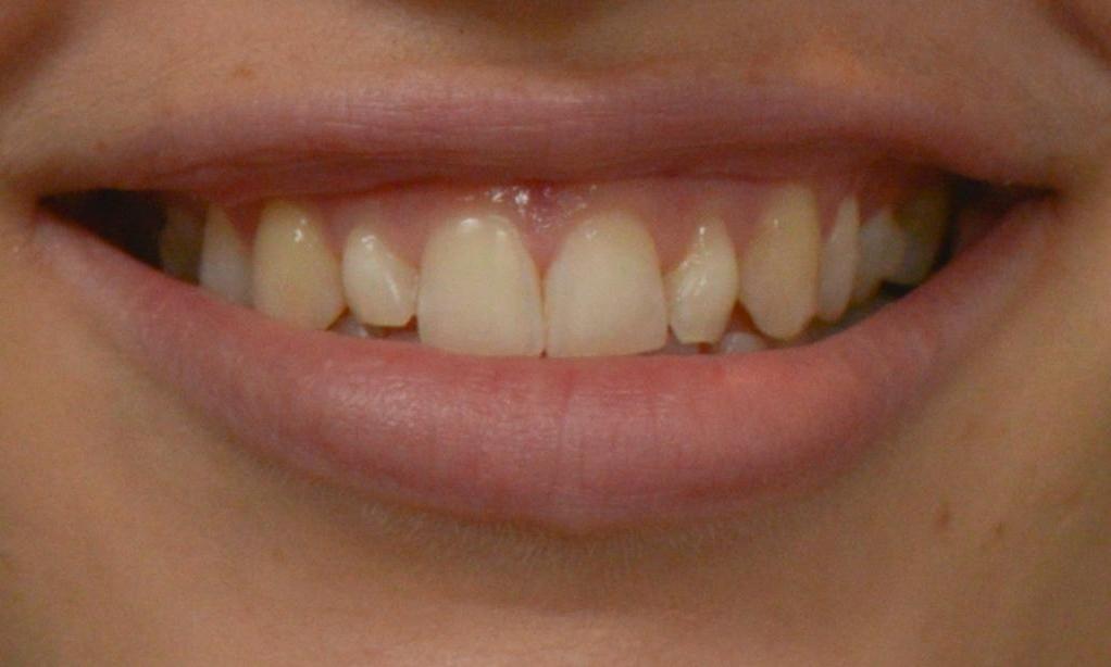 Close up of teeth before Invisalign in Brisbane