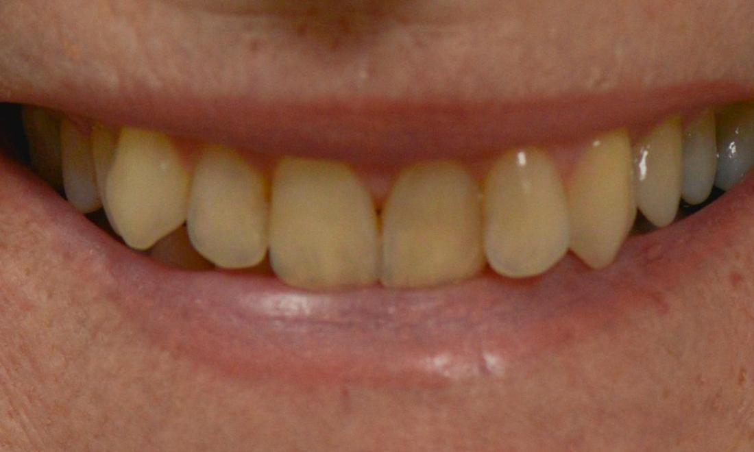 Close up of smile before dental crowns in Brisbane