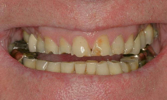 Close up of decayed teeth before dental crowns in Brisbane CBD
