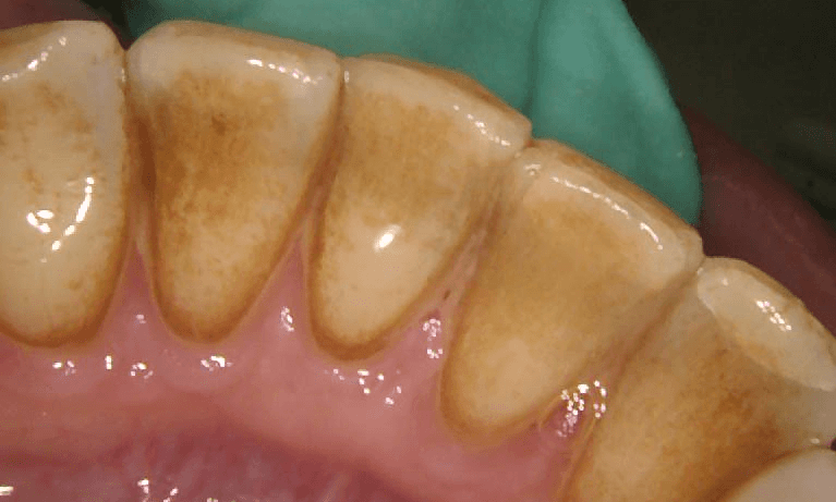 yellowed teeth with periodontal issues