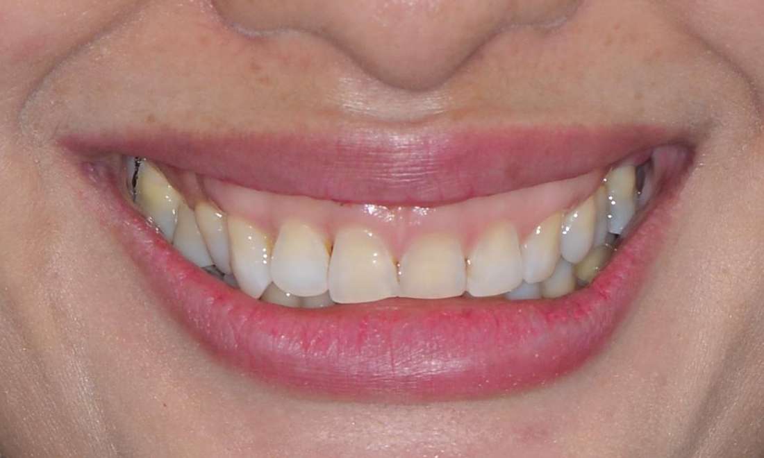 woman with discolured teeth before veneers