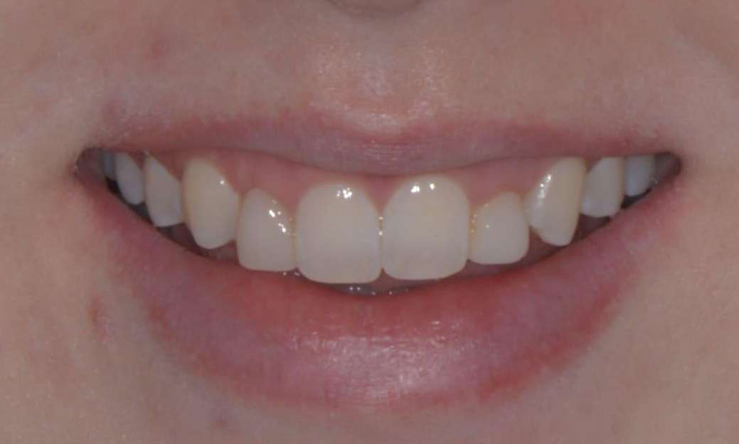Brisbane Residual Baby Teeth