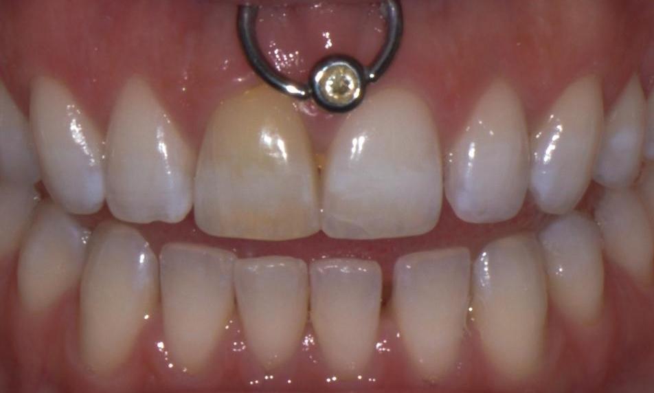 Patient with discoloured front tooth at Brisbane dental clinic