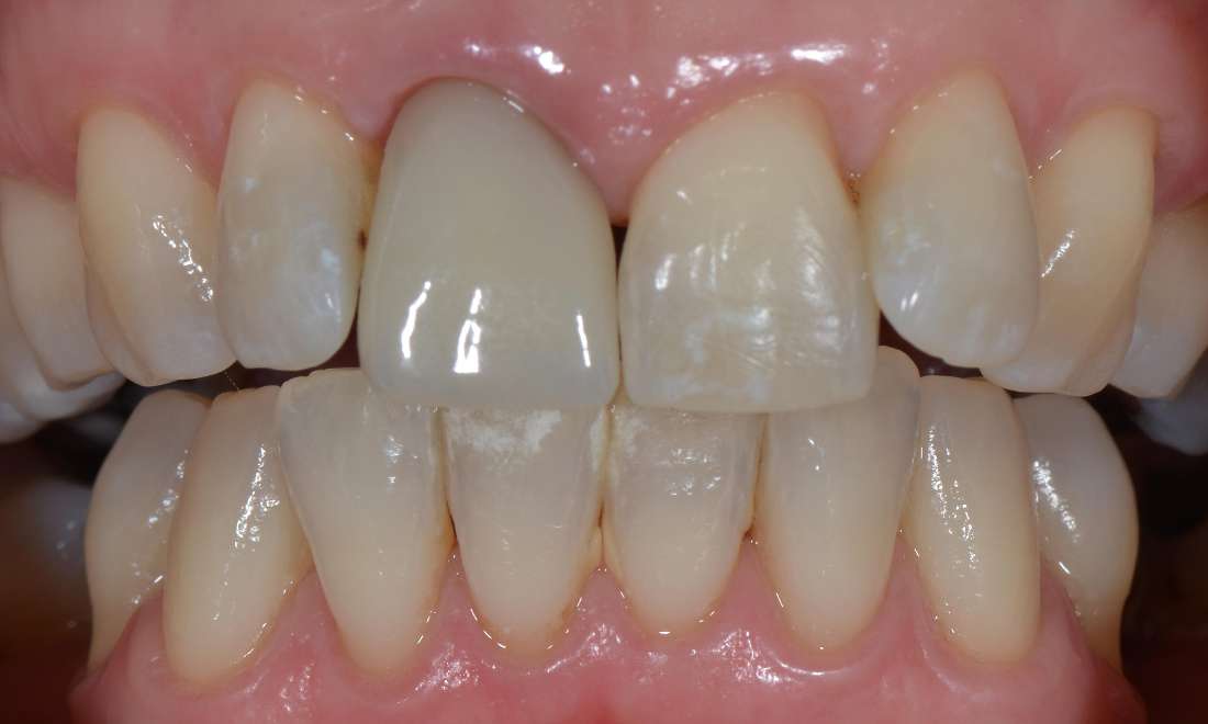 old porcelain crown on front tooth