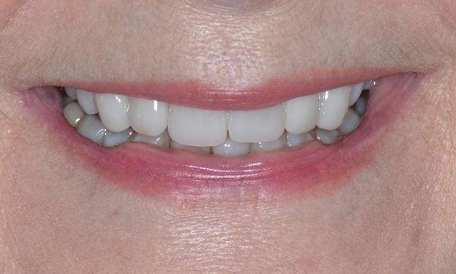 woman's smile before veneers