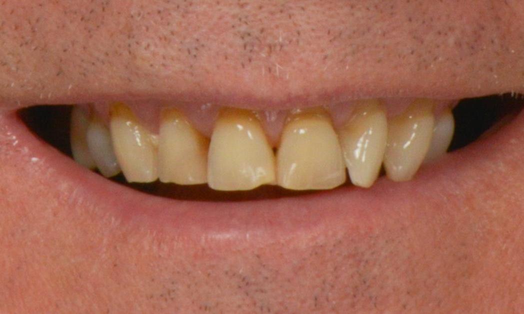 Teeth before full smile makeover at cosmetic dentist in Brisbane CBD