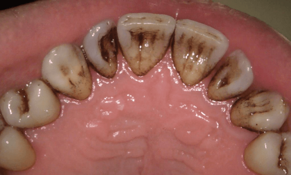 Before teeth cleaning in Brisbane